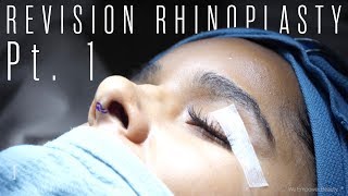 Dr. Steven Pearlman - Revision Rhinoplasty Surgery - Part 1
