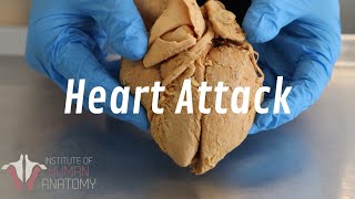 The Anatomy of a Heart Attack