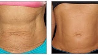 IN 5 DAYS SMOOTH YOUR SAGGY STOMACH PERMANENTLY.