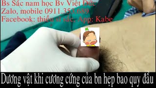 Hình ảnh kHI DƯƠNG VẬT CƯƠNG CỨNG CỦA BN HẸP BAO QUY ĐẦU- Bs Sắc nam học Bv Việt Đức