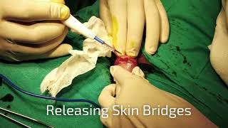 Skin Bridges,Stitchless Circumcision Surgery Dr.Sachin Kuber +919370240098/9370275336
