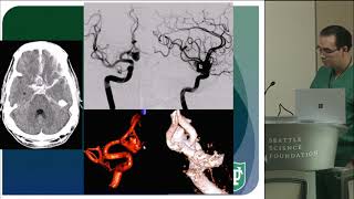 Decision Making in Clipping vs Coiling - Aaron Dumount, M.D.