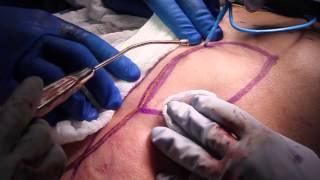 Pectoralis Major Myocutaneous Flap