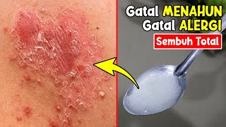 RESEP TERBARU DAN TERMANJUR! CARA MENGOBATI ALERGI GATAL GATAL DI BADAN SECARA ALAMI 