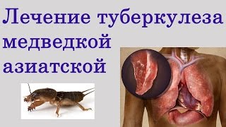 Как лечить туберкулез легких при помощи азиатской медведки?