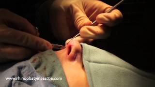 How to insert an Alar Batten Graft | Breathe Right Strip Surgery | Seattle Rhinoplasty