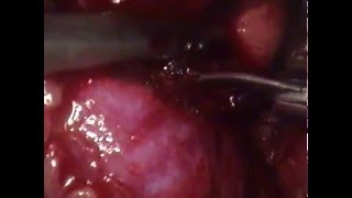 Left Laparoscopic Partial Nephrectomy 20160219