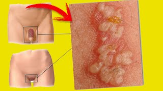 Síntomas Del Herpes Genital - Todo Lo Que Necesitas Saber