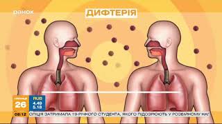 Осторожно, дифтерия: как уберечься от болезни?