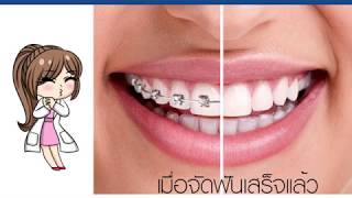 ขั้นตอนการจัดฟัน คลินิกทำฟันอ่อนนุชสกายเทรน #ขั้นตอนการจัดฟัน #จัดฟัน #ดัดฟัน