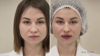 УВЕЛИЧЕНИЕ ГУБ