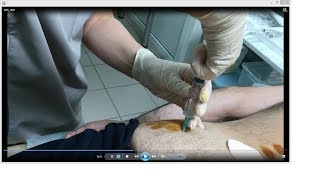№ 925. Б-нь Паркинсона и метод RANC (3-й Курс). Процедура RANC.