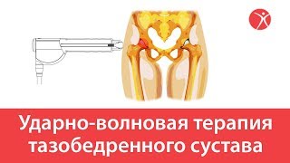 Ударно-волновая терапия тазобедренного сустава в клинике Стопартроз