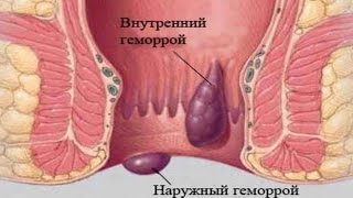 ★Как быстро вылечить геморрой в домашних условиях. Простые, но эффективные средства.