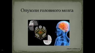 Опухоли головного мозга. Презентация для непосвященных.