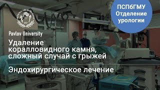 Удаление коралловидного камня, сложный случай с грыжей | Гаджиев Нариман Казиханович, уролог-хирург