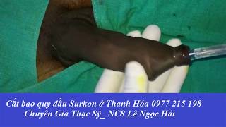 Cắt bao quy đầu cho bệnh nhân nước ngoài bằng máy Surkon 0977 215 198