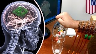 脳にチップ埋め込み、麻痺した右手を動かすことに成功　米・オハイオ州