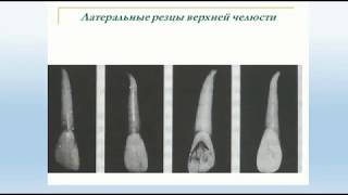 Анатомия латерального резца верхней челюсти