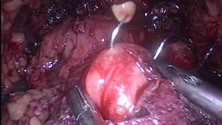 Laparoscopic radical prostatectomy          Лапароскопическая радикальная простатэктомия