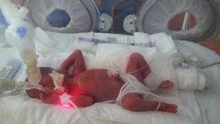 Born at 25 Weeks: Micro-Preemie Documentary