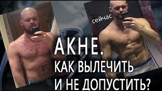 Как вылечить акне и не допустить его появления? Качкам и не только.