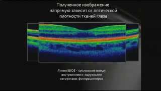Диковская М.А. Современные методы диагностики заболеваний сетчатки Оптическая когерентная томография