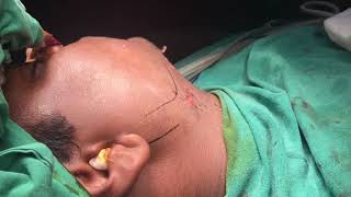 Keyhole surgery for lower jaw fractures video @ Richardsons