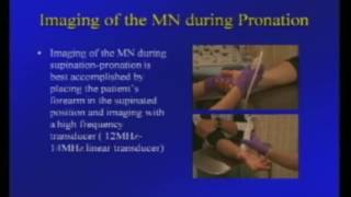 Ultrasound Analysis of Median Nerve in Carpal Tunnel Disease