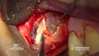 SINUS LIFT AND LATERAL WINDOW