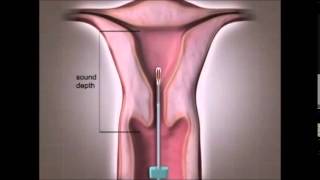 Spiral Nedir, Spiral Nasıl Takılır, Hormonlu Spiral Fiyatları Spiral Zararları Yan Etkileri Video