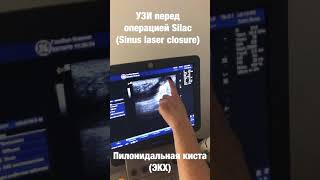SiLaC операция на эпителиальном копчиковом ходе,лазер, пилонидальная киста