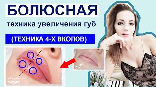 Болюсная техника / Техника 4-х вколов УВЕЛИЧЕНИЯ ГУБ