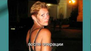 Желудочное шунтирование - история преображения.