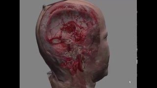VP Reveal-  3d dicom viewer - Showcase