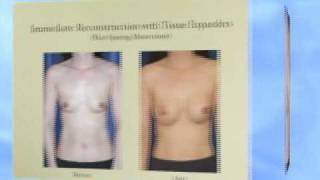 Dr. David T. Morwood - Breast Reconstruction - A Ten Minute Summary