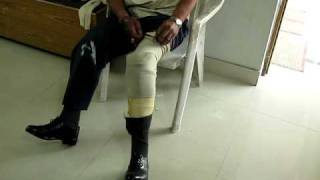 Artificial limb-B/L B.K amputee with prosthesis
