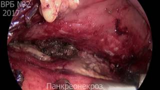 Панкреонекроз