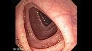 Colonoscopia Normal