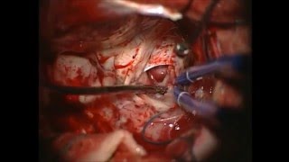 Операция. Удаление глиобластомы базальных отделов левой лобной доли