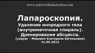 Лапароскопия. Удаление инородного тела(внутриматочная спираль). Дренирование абсцесса.