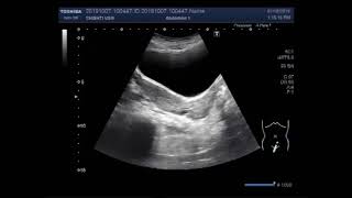 Ultrasound Video showing a case of Uterus didelphys.