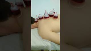 Хиджама в Махачкале на Атаева 7 Д