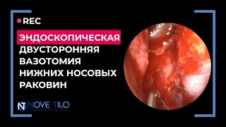 Лазерная эндоскопическая двусторонняя вазотомия нижних носовых раковин