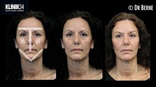 MTV-Lift Harmony Approach Restylane and Azzalure fullface treatment