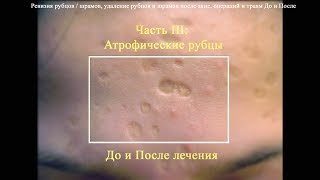 Часть III: Атрофические рубцы и рубцы после акне до и после лечения