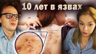 ФУРУНКУЛЫ ПО ВСЕМУ ТЕЛУ | Обзор | Я стесняюсь своего тела