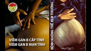 Viêm gan B mạn tính - Viêm gan B cấp tính - Bệnh không thể coi thường | PKCK Gan Tâm Đức