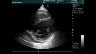 ECHOCARDIOGRAPHY ISCHEMIC HEART DISEASE DOPPLER