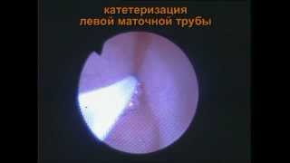 Проверка  маточных труб без боли и без рентгена.
